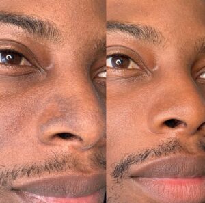 Woody McClain Instagram - This discussion on sunscreen is crucial. I developed melasma in college from excessive sun exposure. Sunscreen wasn’t a priority back then as everyone believed we didn’t require it.

Managing melasma typically involves using sunscreen daily, wearing protective clothing, avoiding sun exposure during peak hours, and using skincare products containing ingredients like hydroquinone, retinoids, or vitamin C. 

I'm just trying to put y'all on 🙌🏾