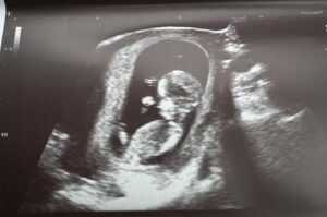 Annie Clark Instagram - Throwback to June 4 when we found out I got the best birthday gift ever. So excited for our next chapter. Baby Karaim coming Feb 2025 ❤️