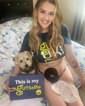 Katie Piper Instagram - Todays #MindsetMonday comes from @stomachick.x_x, she says “In 2014 at just 21, an age I nearly didn’t make it past. I endured one of the hardest times and I’ve gone through for major life saving & life changing surgery for an ileostomy stoma bag due to a rare life-threatening bowel disease known as Hirschsprung’s. 

I also have multiple other complex conditions/ disabilities. I was told my bowel was packing up & was no longer working as it should to keep me alive. I spent most of my teens in & out of hospital, on tons of different medications, painkillers & endless laxatives. Even trialing medication that weren’t out yet and dealing with a tonne of different debilitating symptoms, from not opening my bowels for five months, extreme bloating weight/blood loss, nausea/vomiting & excruciating pain & more. 

My surgery was complex & 5 days later I was rushed back in & nearly died due to a perforated & twisted bowel, sepsis, & multiple other complications which I required multiple IV meds, tubes NG/ feeding & blood transfusions for.

Being chronically disabled has resulted in me having a lot of surgery & tons of procedures in the last 10 years. Loss of organs & my ability to have children naturally & potentially at all. I recently had my 13th surgery which was during my IVF treatment. Which has sadly failed. 

I still deal with a lot with my health & I’m on morphine daily. But going through extensive trauma at such a young age has shown me how precious life is & having your health can be. 
My Stoma saved my life, I will always continue to try to erase the stigma around ostomy bags & invisible illnesses, as well as showing my true beautiful self.”