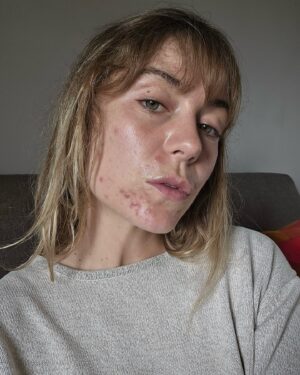 Ana Marta Ferreira Instagram - Sinceramente? Nunca pensei que este dia chegasse!
Toda a minha vida tive acne. Já tive várias fases. Com mais acne no inverno, menos no verão, mas NUNCA sem acne totalmente.

Até que um dia, recomendaram-me o @dr.luis_uva (obrigada @ana.rebelo_ e @ricardo.carrico_oficial)... e não é que finalmente encontrei o melhor?

Com a medicação certa para mim e os tratamentos adequados ao meu problema, passados uns meses estava assim: sem acne!!!! 🥹🥹🥹

Obrigada Dr. e a toda a equipa incrível que me tem acompanhado e tratado de mim ❤️ Nunca pensei um dia sentir-me melhor sem maquilhagem do que maquilhada!!!

Obrigada!!!