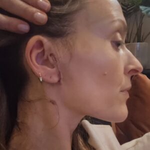 Fearne Cotton Instagram - The human body is incredible. In less than three weeks you can barely notice where I had the tumour removed. I feel almost normal. My ear is still quite numb and my face a little tender but other than that I'm feeling good. 
Only swipe if you want to see the gradual stages of healing. It's not massively gruesome but it certainly looks worse than photo number 1. I found the whole process fascinating and feel very grateful that the operation went well and that the tumour was benign. My surgeon Professor Oflynn made me feel extremely calm and all the nurses were complete angels. Nurse Jackie was especially amazing whilst I was in hospital telling me to get off my phone and nap etc. I needed a firm telling off at times. 🤣
Feeling grateful that I'm healing well and will always wear this scar with pride. A reminder to slow down and look after myself.