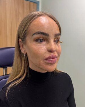 Katie Piper Instagram - After many years battling with my eye health, I’ve reached the end of road somewhat, and the decision has been made to try a prosthetic eye shell. 

This marks the start of a journey to have an artificial eye, with an incredible medical team behind me. As always I’m incredibly grateful to all those in the NHS and private health care system for their talent and kindness.

I will share my journey, I’m hopeful and nervous about being able tolerate it and would love to hear from any of you in the comments if you’ve been on this journey or have any advice…