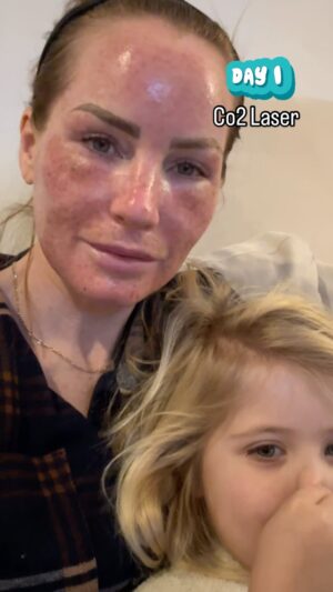 Mina Starsiak-Hawk Instagram - I’m about to have the baby fresh skin…. Once I’m done being a monster. 🫣
::::::
It’s grosse, but putting it all out there for those who are interested, those who are not but like grosse stuff and those who compare themselves to others who maybe haven’t been so open about their physical looks. 
::::::
Hate me for it or love me for it. And I’d rather you have to explain to your adolescent child what this crazy lady did to make her face look like a babies butt than you have to explain to them why they don’t look like the other girls/boys/fill in the blank they see online who are altered or are probably full on AI at this point. 🤷🏼‍♀️
::::::
If you’re 40 and your face doesn’t look like mine, you’ll at least know it’s because I spent money to torture myself to get that fresh to death skin. 
::::::
So be cool to each other (and to me). Thanks for coming to my Ted Talk ✌🏼