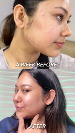 Aditi Shrestha Instagram - PCOS girlie on a mission today:
💪 Protein-packed breakfast
📸 Content shoot
🫶🏼Self-care therapy!

Aaaaand my favourite @novologyofficial Acne Reduction Serum to the rescue for hormonal acne.

Lightweight, dermatologist-approved, and perfect under makeup. Skin feels fresh & clear in a week! 🌿

#Ad #MiniVlog #PCOSJourney #Acne #Skincare
