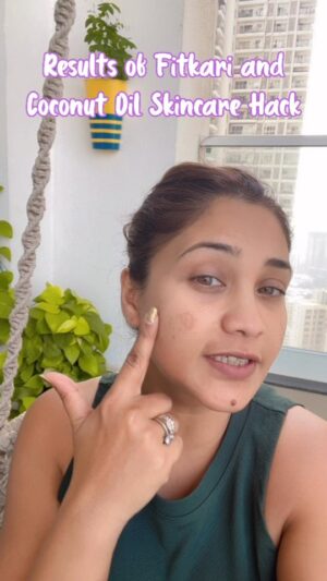 Amrapali Gupta Instagram - So I got alot of comments on what was the result of my Fitkari and Coconut Oil Skincare Hack. Here it is , slowly I am getting there. Let me know what are the results after you applying it !! 🤗

SkinCare Hacks, Ghar Ke Nuske, HomeMade Remedies, Skincare, Pigmentation

#skincarereview #skincareroutine #freckles #pigmentationsolution #skincarenatural #HomeRemedies #homemadeskincare #resultmatters #trynow #amrapaligupta