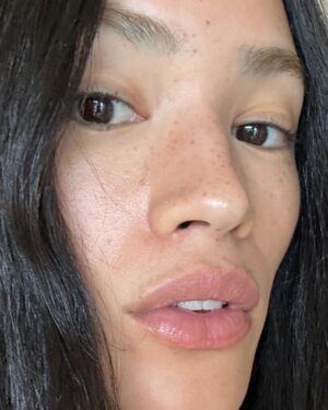 Mette Instagram - Sunburnt mosquito bites.