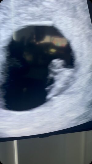 Victoria Charlton Instagram - This Is US 💖

Le 31 décembre dernier, à minuit, Bob et moi on s’est embrassé, on s’est souhaité la bonne année et il m’a dit : “let’s put a bun in the oven” 🥹
Un an plus tard, notre souhait a été exaucé et notre p’tit bébé est avec nous pour célébrer l’année 2025 qui arrive ! 🥠