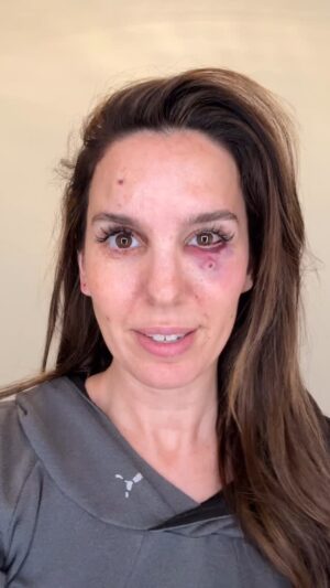 Christy Carlson Romano Instagram - Yesterday was my husband’s birthday and I took him to shoot clay pigeons as a present. There was another party with us and they unsafely fired in the wrong direction and shot me in the face. @thebrendanrooney immediately sprung into action, assessed me, and rushed me to the hospital. I was hit in 5 places, one was less than an inch from hitting me directly in my right eye. 

Unfortunately a fragment got lodged behind my eye and it is too risky to remove surgically at this time. Doctors will continue to monitor me (I can see normally at the moment).

With everything that happened, all I can think about is how grateful I am to be alive. I love my daughters, husband, family, and friends so much. I saw my life flash before my eyes and I’m telling you, hug the people around you every chance you can. Life can change in an instant. 🙏