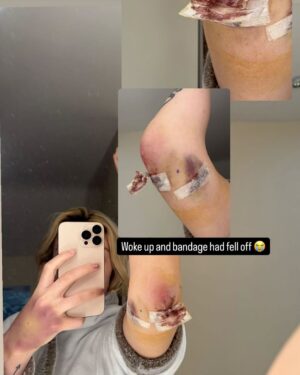 Leah McCourt Instagram - Day 14 post elbow surgery.  Can’t thank @kingsbridgeprivatehospital enough. The most amazing staff, nurses and doctors.  Especially thanks to Anthony McKenna and my surgeon Neville Thompson.  The floating body was so big he had to end up operating through my triceps tendon to remove it. 

Ready to start rehab and can’t wait to get back training.  Thanks to all my team.  Back soon @nextgenmmalpool @rygorpaul @forgephysioni @tommiddlebrough

And shout out to my Isabella helping me and getting straight A’s in her exams 📝👩‍🎓🩷