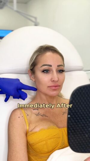 Mary Fitzgerald Instagram - As we age, the jawline can lose definition due to volume loss and changes in skin elasticity. Neustem™ injections in the mandible area offer a non-surgical solution to restore a more lifted, contoured appearance—without the need for surgery or downtime. This advanced treatment at Epione Beverly Hills is designed to enhance jawline definition with natural-looking results.

Interested in learning more? Comment “JAWLINE” below for treatment information.
 #JawlineContouring #Neustem #DrSimonOurian #EpioneBeverlyHills #NonSurgicalEnhancement #FacialRejuvenation