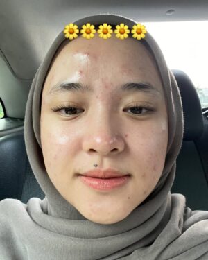 Nissa Sabyan Instagram - sebelum dan sesudah treatment di klinik @dermaster_id 😍🫶✨

perjalanan Acne ku😊
slide 1-3 itu tanggal 1 juli 2024 foto muka ku yg lg breakout karna gak cocok pakai makeup😭😭😭 dan aku lgsng buru2 treatment ke @dermaster_id 
slide 4-7 itu tanggal 3 agustus 2024 setelah aku treatment di @dermaster_id Alhamdulillah jerawat ku sembuh gessss😭🤲🤗

Thank u @dermaster_id Dokter @dr.sallienaomi and kaka ku sayang @tivanirahmagumay 
please kalian wajib bgt kesana. 10/10⭐️