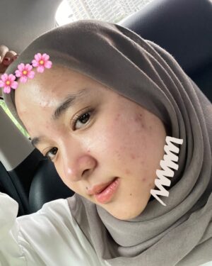 Nissa Sabyan Instagram - sebelum dan sesudah treatment di klinik @dermaster_id 😍🫶✨

perjalanan Acne ku😊
slide 1-3 itu tanggal 1 juli 2024 foto muka ku yg lg breakout karna gak cocok pakai makeup😭😭😭 dan aku lgsng buru2 treatment ke @dermaster_id 
slide 4-7 itu tanggal 3 agustus 2024 setelah aku treatment di @dermaster_id Alhamdulillah jerawat ku sembuh gessss😭🤲🤗

Thank u @dermaster_id Dokter @dr.sallienaomi and kaka ku sayang @tivanirahmagumay 
please kalian wajib bgt kesana. 10/10⭐️