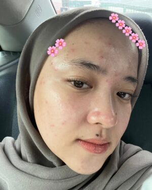 Nissa Sabyan Instagram - sebelum dan sesudah treatment di klinik @dermaster_id 😍🫶✨

perjalanan Acne ku😊
slide 1-3 itu tanggal 1 juli 2024 foto muka ku yg lg breakout karna gak cocok pakai makeup😭😭😭 dan aku lgsng buru2 treatment ke @dermaster_id 
slide 4-7 itu tanggal 3 agustus 2024 setelah aku treatment di @dermaster_id Alhamdulillah jerawat ku sembuh gessss😭🤲🤗

Thank u @dermaster_id Dokter @dr.sallienaomi and kaka ku sayang @tivanirahmagumay 
please kalian wajib bgt kesana. 10/10⭐️