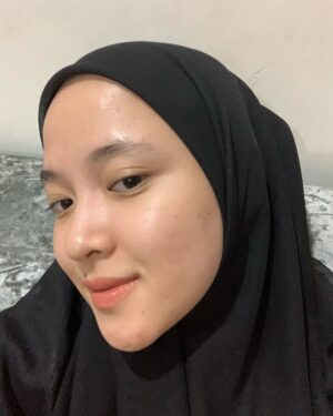 Nissa Sabyan Instagram - sebelum dan sesudah treatment di klinik @dermaster_id 😍🫶✨

perjalanan Acne ku😊
slide 1-3 itu tanggal 1 juli 2024 foto muka ku yg lg breakout karna gak cocok pakai makeup😭😭😭 dan aku lgsng buru2 treatment ke @dermaster_id 
slide 4-7 itu tanggal 3 agustus 2024 setelah aku treatment di @dermaster_id Alhamdulillah jerawat ku sembuh gessss😭🤲🤗

Thank u @dermaster_id Dokter @dr.sallienaomi and kaka ku sayang @tivanirahmagumay 
please kalian wajib bgt kesana. 10/10⭐️