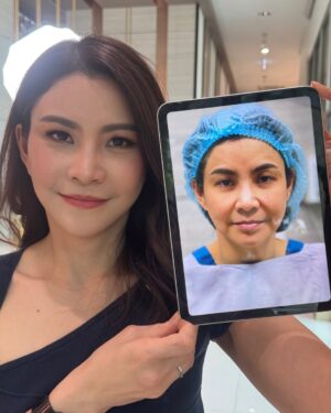 Pimonwan Hoonthongkam Instagram - แค่ 1 เดือน ผ่านไป @mynameisbe คุณบี ปิติภัทร สารสิน✨ Update  หลังดึงหน้าพร้อมเติมไขมันเปลือกตาและร่องแก้ม “ครบ 1 เดือน 

#DeepFaceLift
#ดึงหน้าชั้นลึก