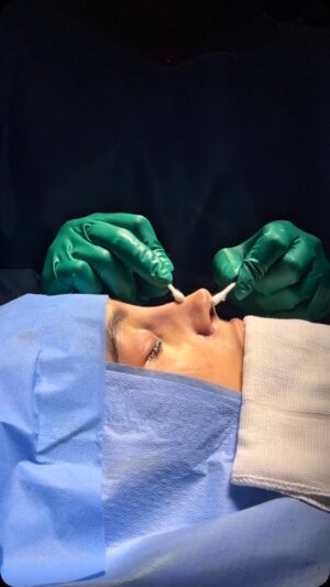 Sandri Oliveira Instagram - Minha missão é transformar sonhos em realidade com técnica e precisão! ✨ 

Nesta rinoplastia primária, usei cartilagem de costela para esculpir um nariz delicado e definido, do jeitinho que minha paciente sempre sonhou. 

Resultado leve, natural e em total harmonia com o rosto! 💖 #Rinoplastia #NarizDelicado #harmoniafacial #dramarcelasuman #narizperfeito #rinobrasilia #fy