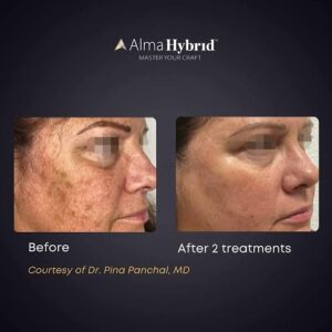 Sue Duminy Instagram - All the honour and credit to @sands_aesthetics for healthy skin.. my skin has always been my biggest and my most vulnerable challenge.. I struggled with bad acne when I was younger and was left with bad marks, big pores, fine lines and wrinkles.. I would NEVER leave the house without make-up. It became a mental challenge which would later then dictate my life. So when I speak about skin, I not only speak about “skin”, I speak about all those layers of feeling “ugly”, “not good enough”, “not pretty enough”.. these are real things us women struggle with everyday.. Our skin is the first thing people see when they meet us/engage with us.. therefor it’s an important part of our confidence and self-worth.. 
I started investing in my skin and got to the opportunity to take hands with @sands_aesthetics and through a skin journey, (and a journey of self-love and acceptance for who I am) I’ve managed to rip these layers off.. my skin is not 100% flawless, I don’t want it to be, and it never will be.. but sometimes a little Alma Hybrid magic and the acceptance of who we are makes this invisible burden a lot lighter.. 🙏💫