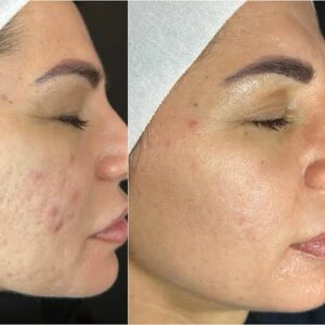 Sue Duminy Instagram - All the honour and credit to @sands_aesthetics for healthy skin.. my skin has always been my biggest and my most vulnerable challenge.. I struggled with bad acne when I was younger and was left with bad marks, big pores, fine lines and wrinkles.. I would NEVER leave the house without make-up. It became a mental challenge which would later then dictate my life. So when I speak about skin, I not only speak about “skin”, I speak about all those layers of feeling “ugly”, “not good enough”, “not pretty enough”.. these are real things us women struggle with everyday.. Our skin is the first thing people see when they meet us/engage with us.. therefor it’s an important part of our confidence and self-worth.. 
I started investing in my skin and got to the opportunity to take hands with @sands_aesthetics and through a skin journey, (and a journey of self-love and acceptance for who I am) I’ve managed to rip these layers off.. my skin is not 100% flawless, I don’t want it to be, and it never will be.. but sometimes a little Alma Hybrid magic and the acceptance of who we are makes this invisible burden a lot lighter.. 🙏💫